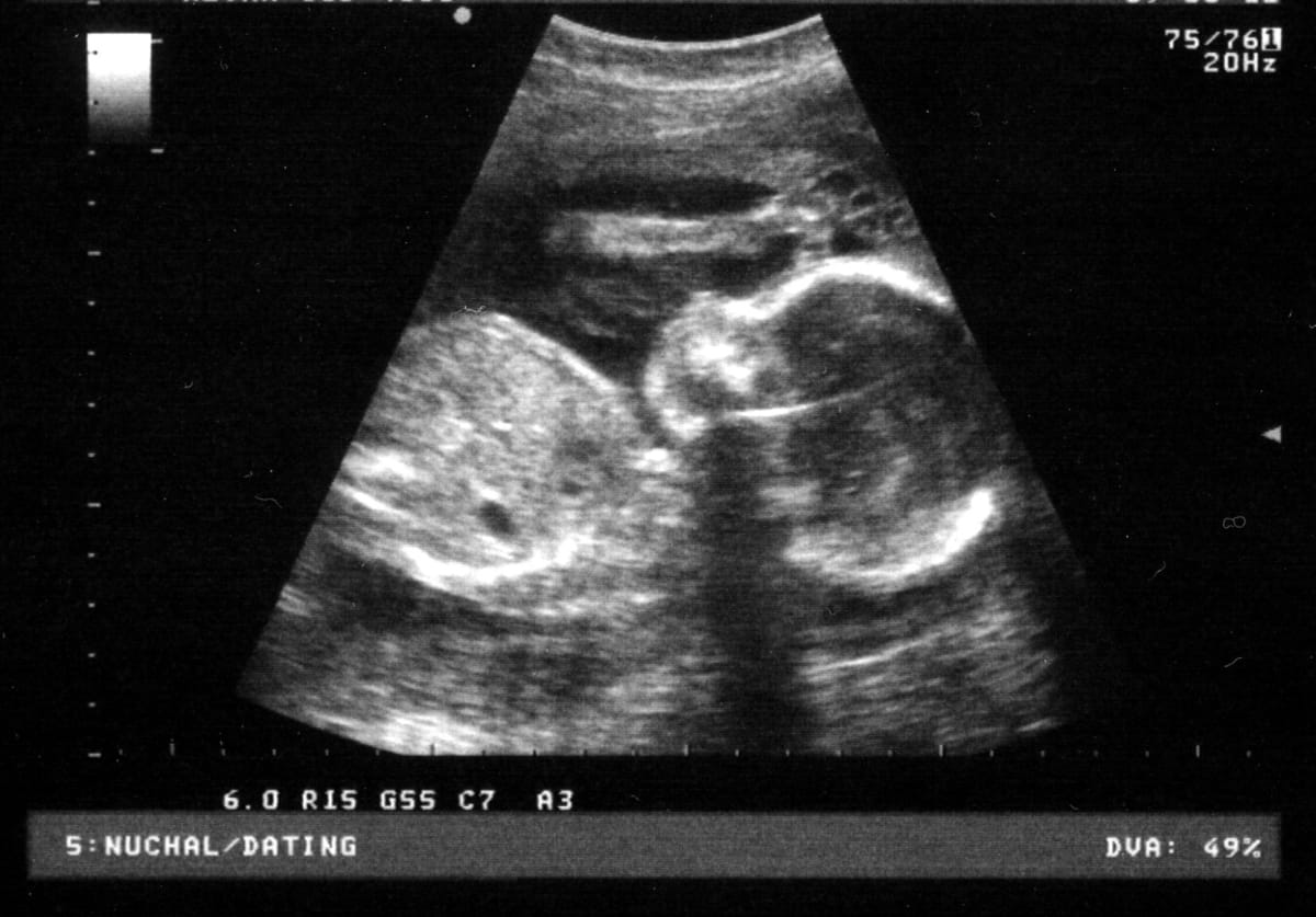 ¿Cómo saber si es niño o niña? – ¡Descúbrelo aquí!