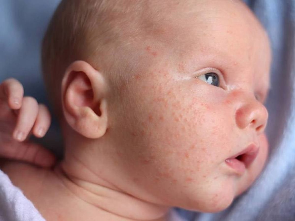 ¿Qué son las sudaminas y cómo afectan a tu bebé?
