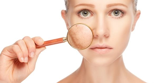 Cloasma o manchas en embarazo: Causas y soluciones